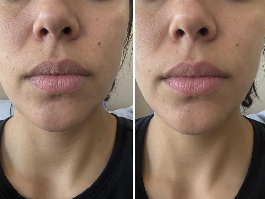 Dry lips before and smoother-looking lips after regular lip balm use