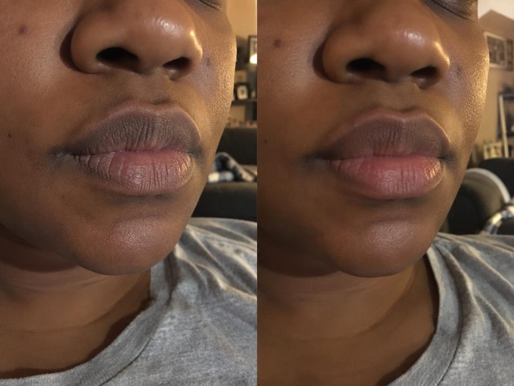 Chapped lips before and hydrated-looking lips after regular lip balm use